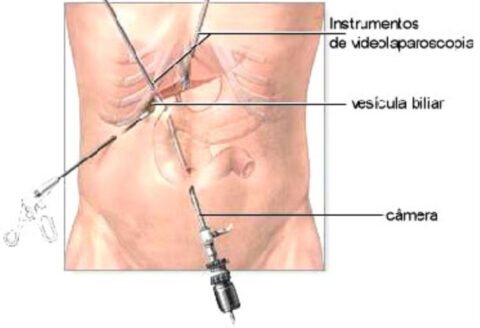 Cirurgia por Vídeolaparoscopia da Gastroclínica de Palmas